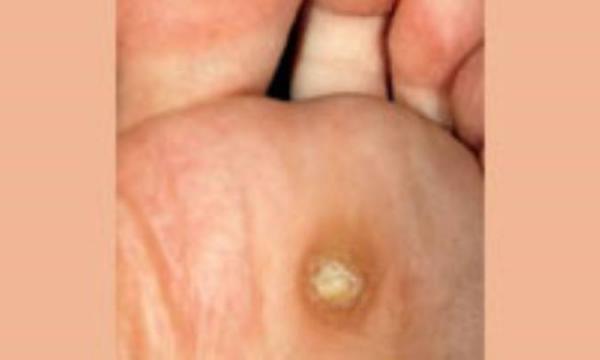 میخچه و پینه در نمای بسته میخچه و پینه در نمای بسته